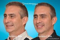 jaw-tension-treated.jpg